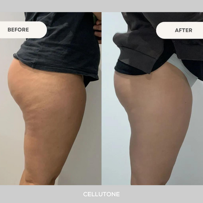 CelluTone™️ | Anti Cellulite Massager